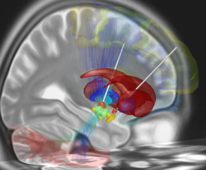 Deep_brain_stimulation_electrode_placement_reconstruction